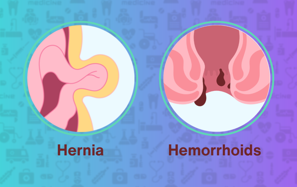 Can a Hernia Cause Hemorrhoids