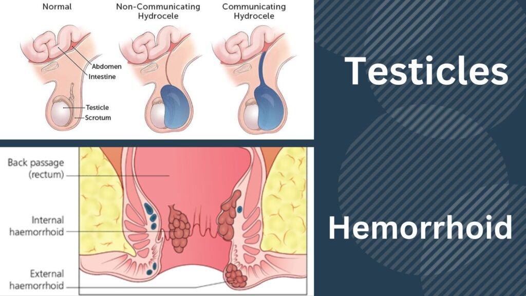 can hemorrhoids cause pain in testicles