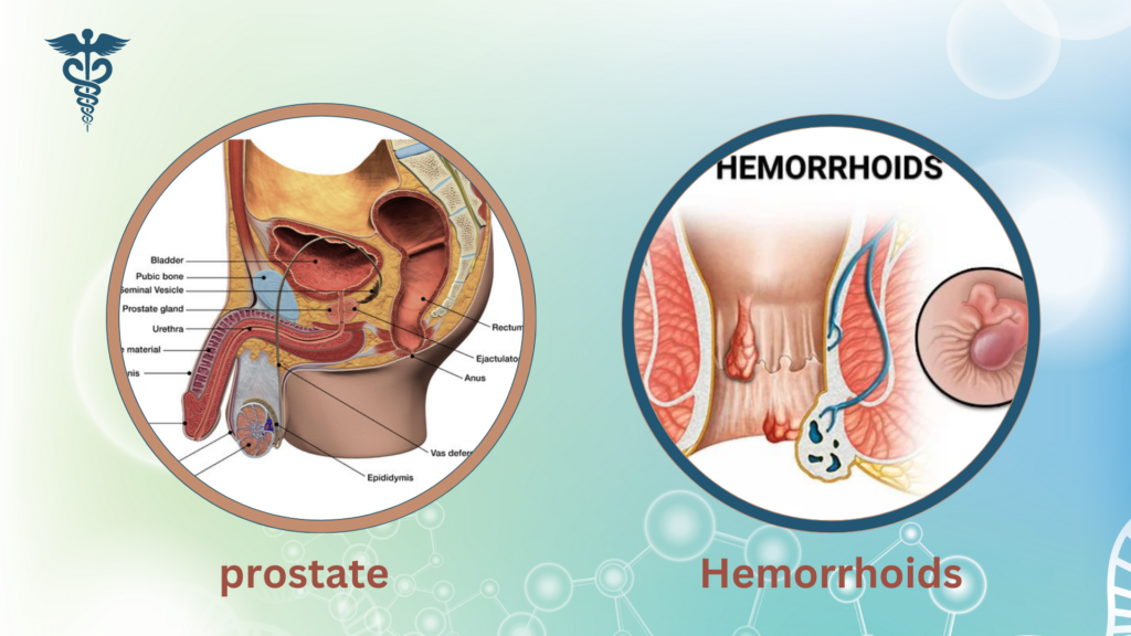 Hemorrhoids and Prostate