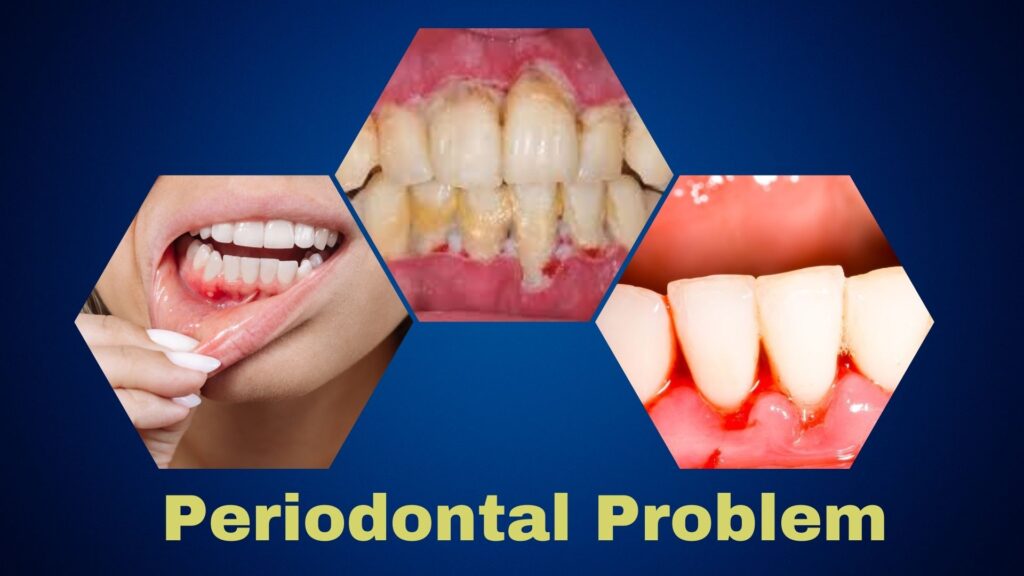 What is Surgical Periodontal Treatment