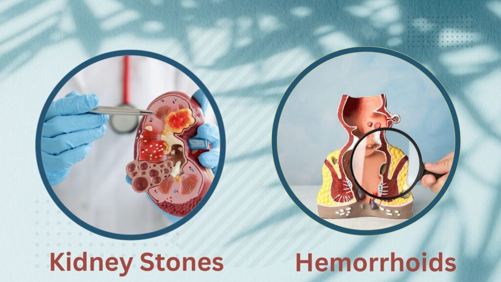 Can Kidney Stones Cause Hemorrhoids